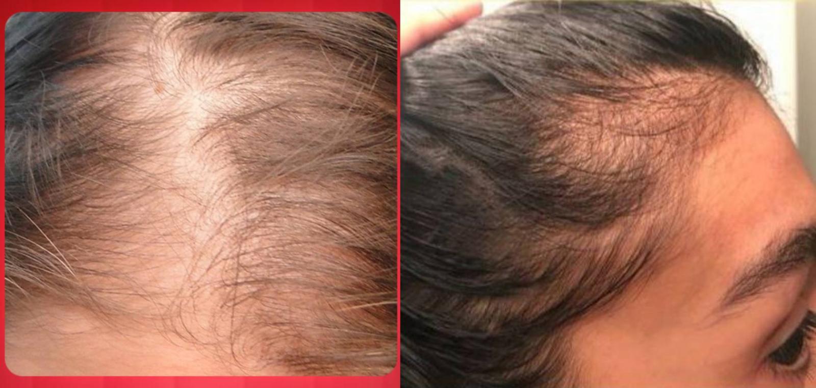 Queda de cabelo após Covid